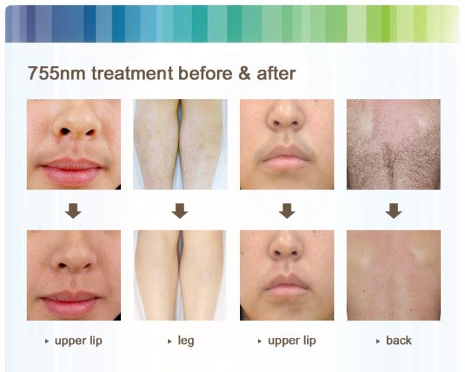755nm Alexandrite Laser Hair Removal For Tiny Hair Permanently Removal CE ISO