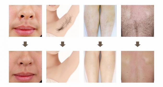 CE Approved Laser Hair Removal Home Machine For Whole Body , 2000W Power Supply