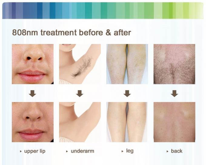 Stationary 808nm Diode Laser Hair Removal Machine Skin Rejuvanation For Salon