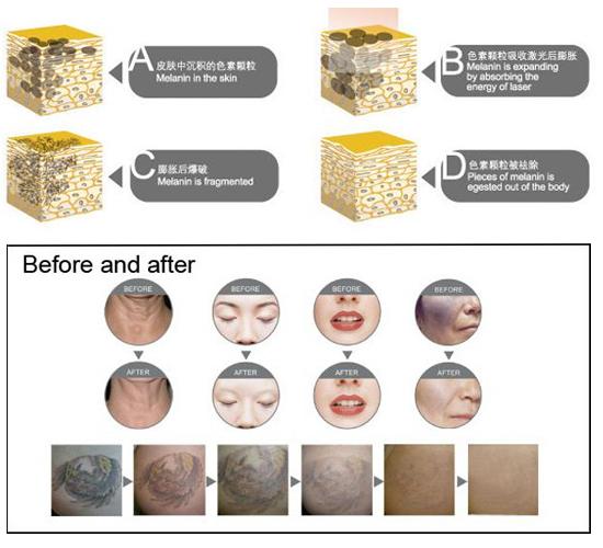 2021年の向くプロダクトalibabaのオンライン店の熱い販売人静止した医学SHR IPLレーザーの美装置