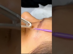 Magneto DPL 3 In 1 IPL Machine ND YAG Rejuvenation Machine For Face