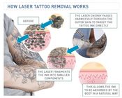 1064nm 532nm Picosecond Laser Machine 755nm Tattoo Removal