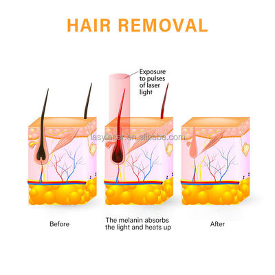 50hz Stationary DPL Laser Hair Removal Triple Wavelength Depiladoras
