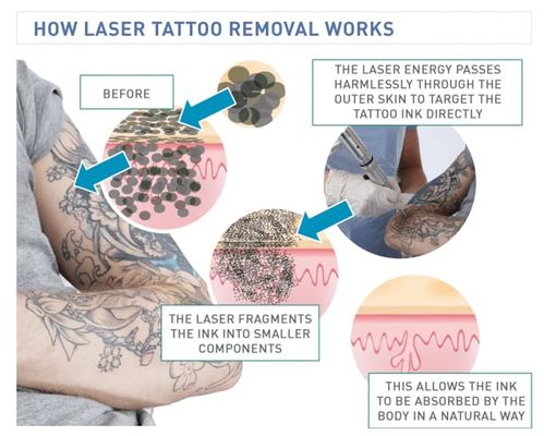 Picosecond Laser Tattoo Removal Machine Q Switch ND YAG Skin Rejuvenation