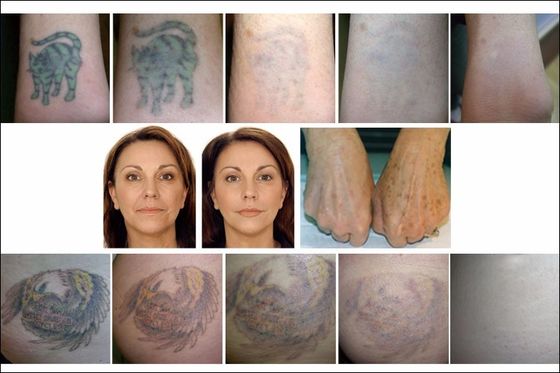 Picosecond Laser Tattoo Removal Machine Q Switch ND YAG Skin Rejuvenation
